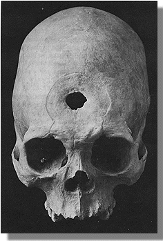 Skull with hole in forehead