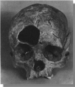 Skull with hole in Forehead over right eye