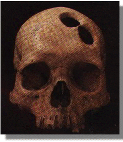 Skull with 2 holes in forehead over left eye