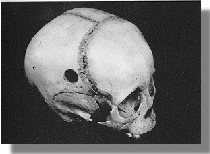 Skull with hole on right side of head