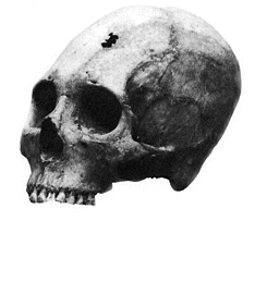 Skull with small hole in middle of forehead